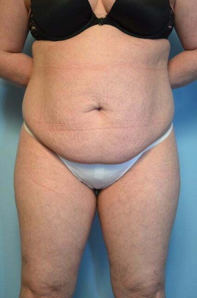Liposuction Before & After Gallery - Patient 224688 - Image 1