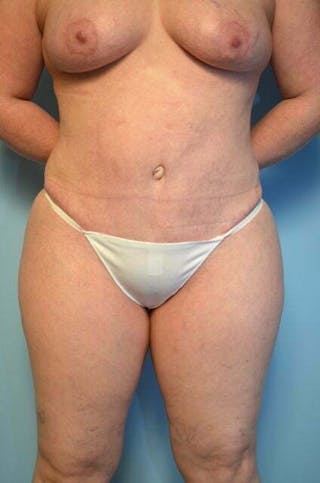 Tummy Tuck Before & After Gallery - Patient 664597 - Image 2