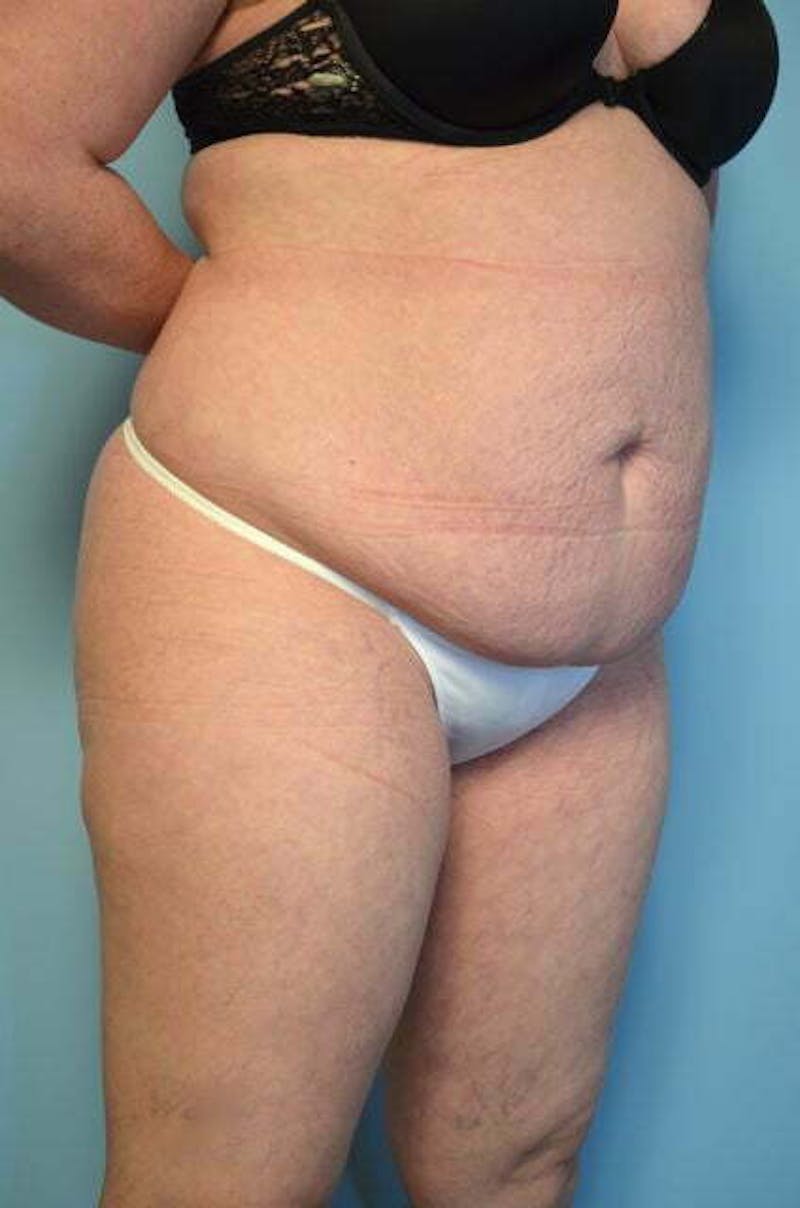 Liposuction Before & After Gallery - Patient 224688 - Image 3
