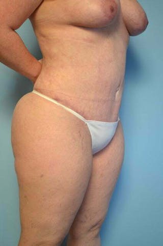 Tummy Tuck Before & After Gallery - Patient 664597 - Image 4