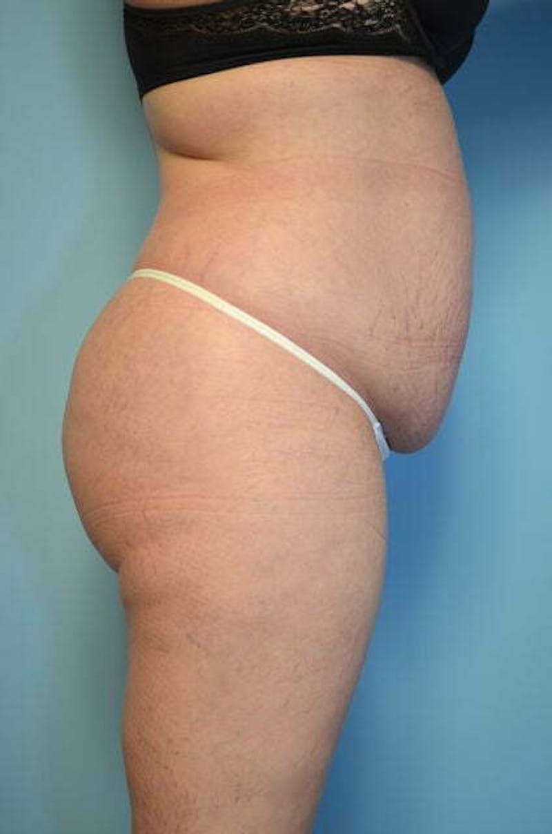 Liposuction Before & After Gallery - Patient 224688 - Image 5