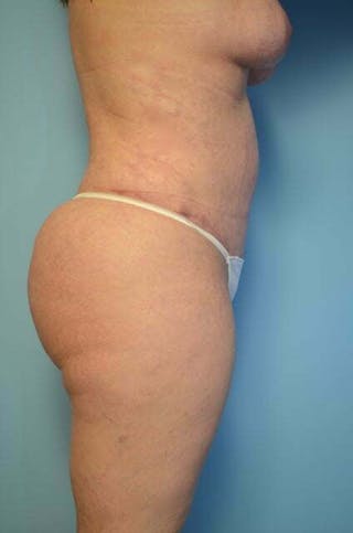 Tummy Tuck Before & After Gallery - Patient 664597 - Image 6