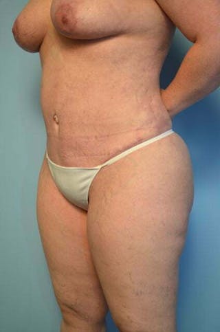 Tummy Tuck Before & After Gallery - Patient 664597 - Image 8