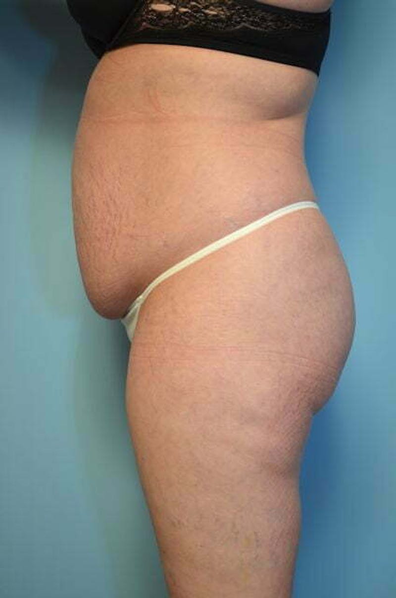 Liposuction Before & After Gallery - Patient 224688 - Image 9