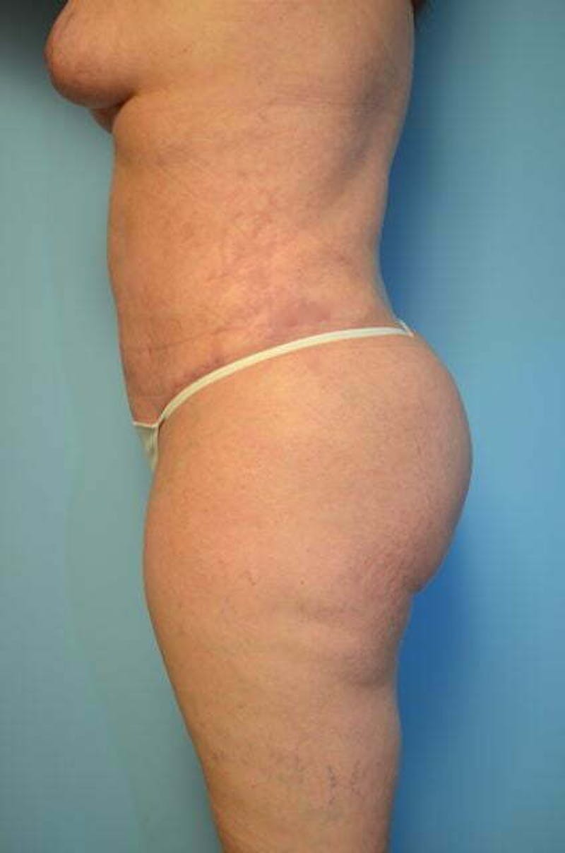 Liposuction Before & After Gallery - Patient 224688 - Image 10