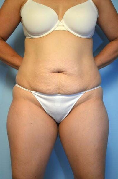 Tummy Tuck Before & After Gallery - Patient 316367 - Image 1
