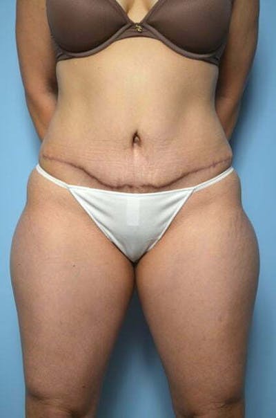 Tummy Tuck Before & After Gallery - Patient 316367 - Image 2