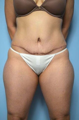 Liposuction Before & After Gallery - Patient 220518 - Image 2