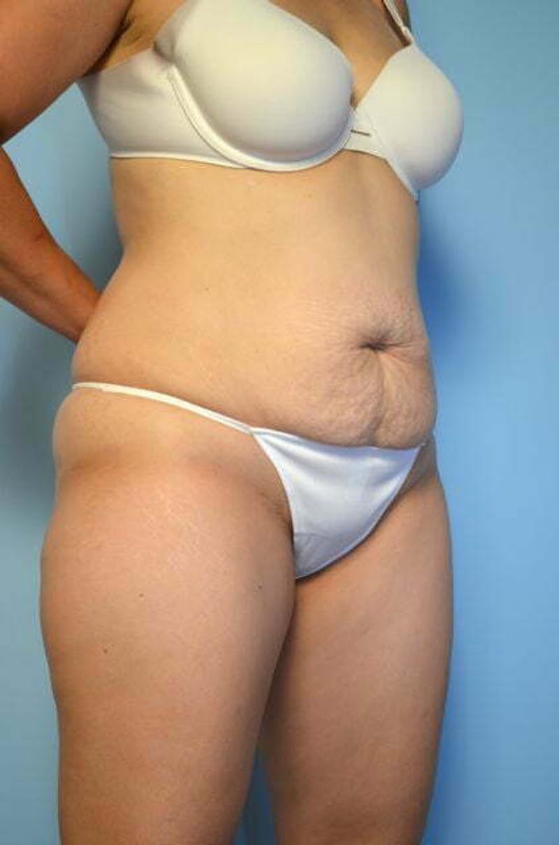 Liposuction Before & After Gallery - Patient 220518 - Image 3