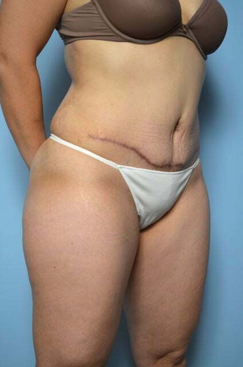 Liposuction Before & After Gallery - Patient 220518 - Image 4