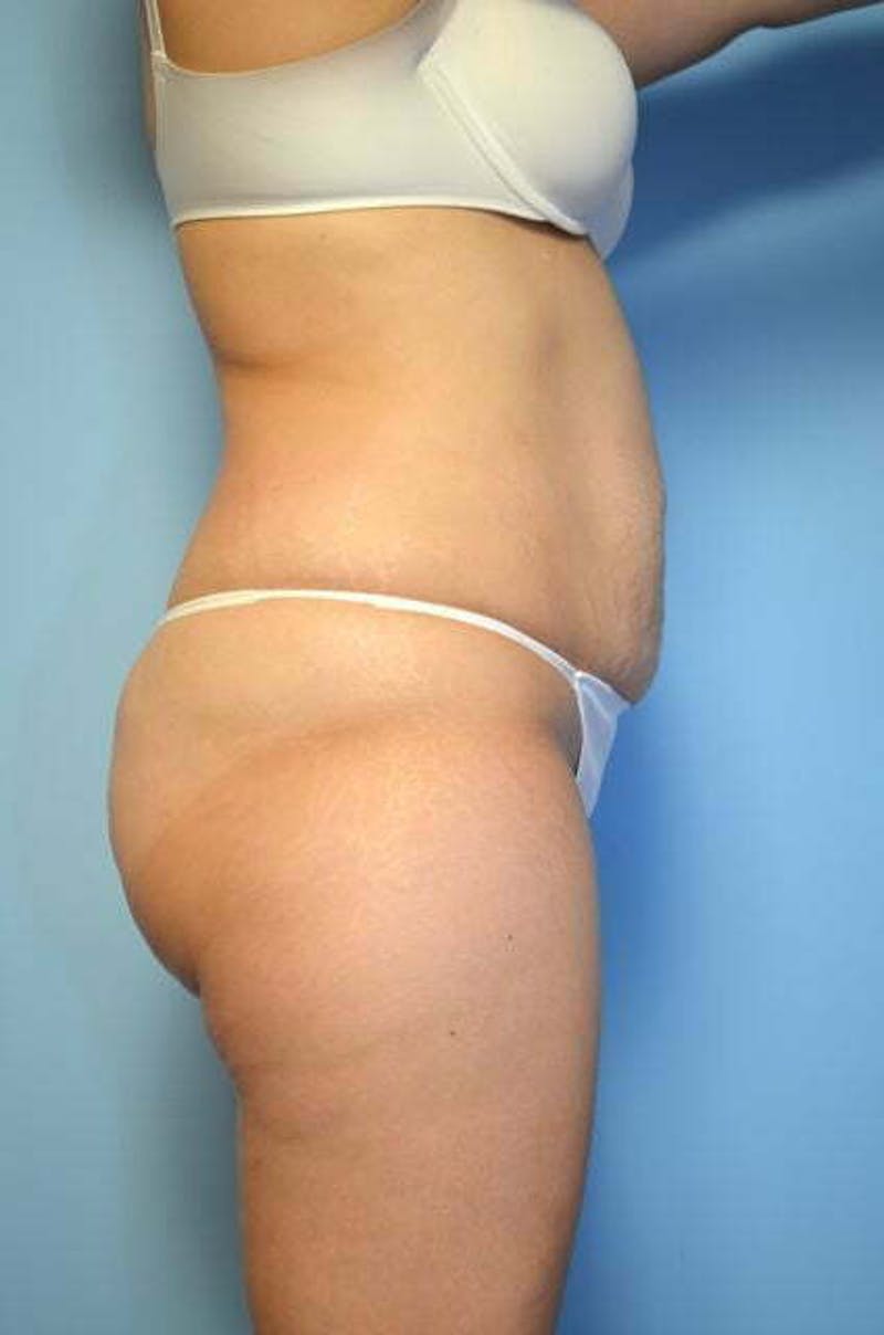 Liposuction Before & After Gallery - Patient 220518 - Image 5