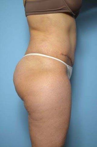 Liposuction Before & After Gallery - Patient 220518 - Image 6