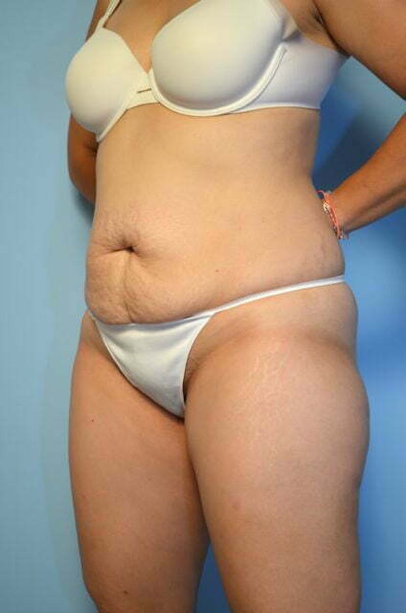Liposuction Before & After Gallery - Patient 220518 - Image 7