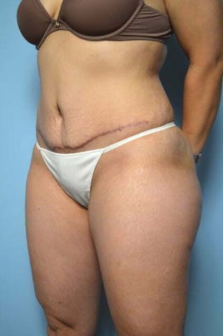 Liposuction Before & After Gallery - Patient 220518 - Image 8