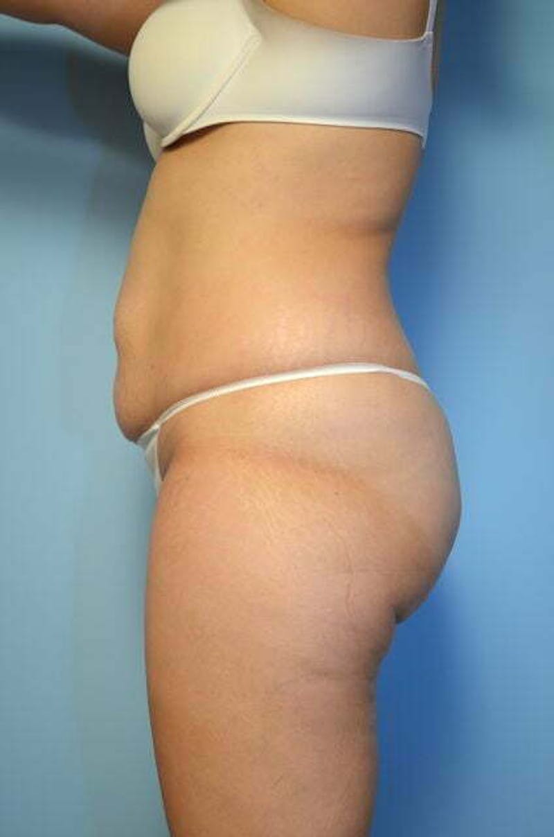 Liposuction Before & After Gallery - Patient 220518 - Image 9