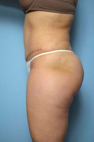 Liposuction Before & After Gallery - Patient 220518 - Image 10