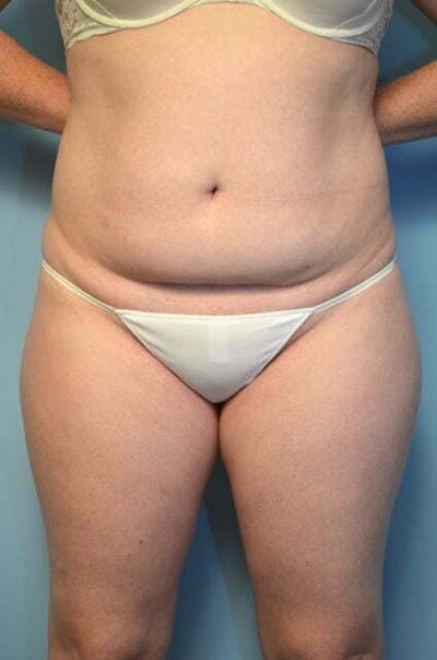 Tummy Tuck Before & After Gallery - Patient 392338 - Image 1