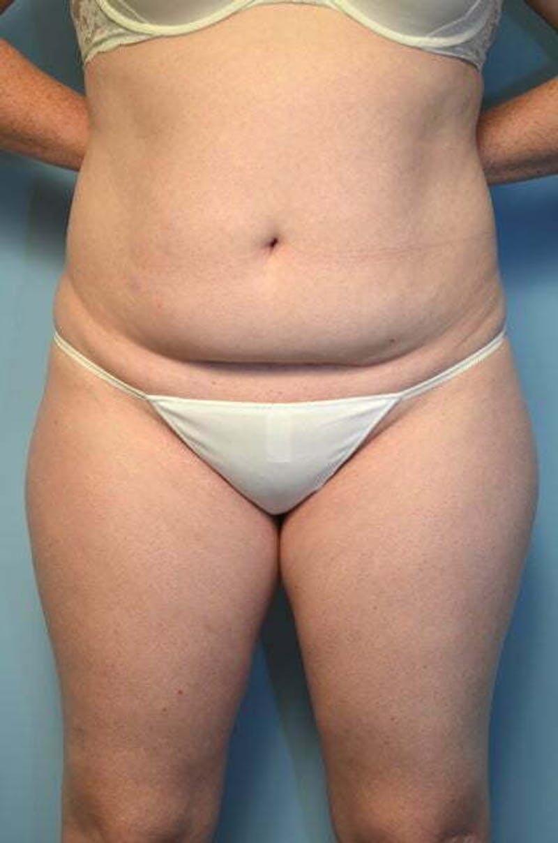 Tummy Tuck Before & After Gallery - Patient 392338 - Image 1