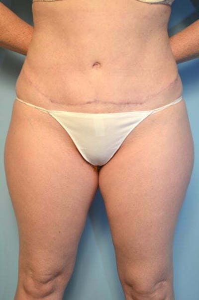 Tummy Tuck Before & After Gallery - Patient 392338 - Image 2