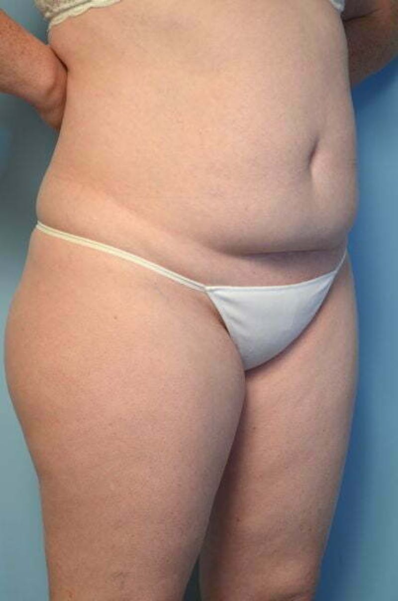 Tummy Tuck Before & After Gallery - Patient 392338 - Image 3