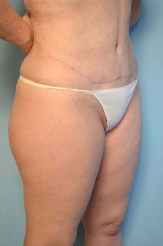 Liposuction Before & After Gallery - Patient 384284 - Image 4