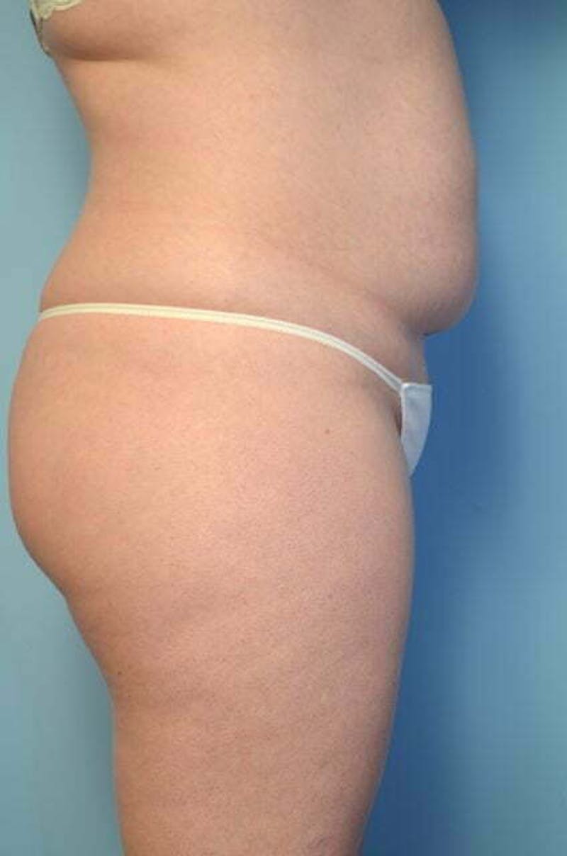 Tummy Tuck Before & After Gallery - Patient 392338 - Image 5