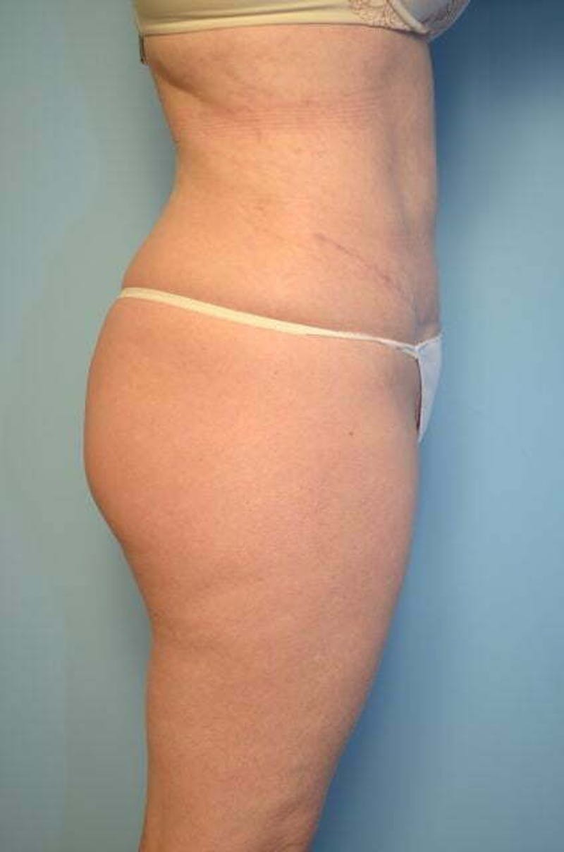 Tummy Tuck Before & After Gallery - Patient 392338 - Image 6