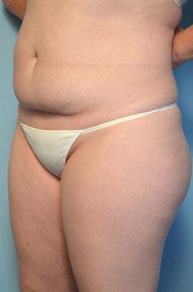 Tummy Tuck Before & After Gallery - Patient 392338 - Image 7