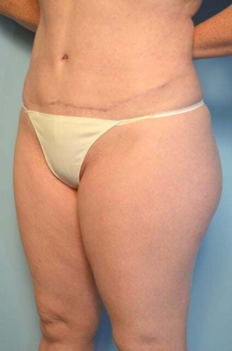 Tummy Tuck Before & After Gallery - Patient 392338 - Image 8