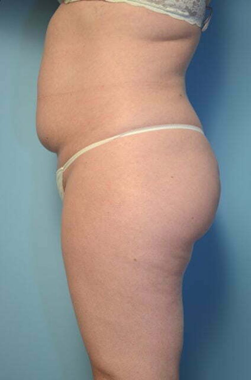 Tummy Tuck Before & After Gallery - Patient 392338 - Image 9