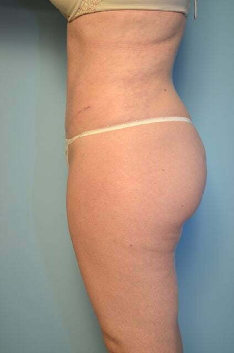 Tummy Tuck Before & After Gallery - Patient 392338 - Image 10