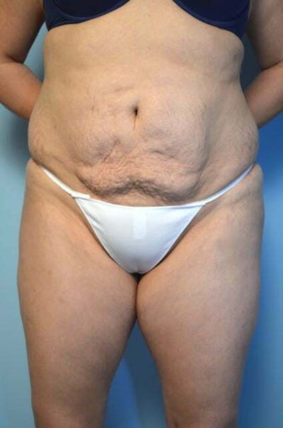Tummy Tuck Before & After Gallery - Patient 606274 - Image 1