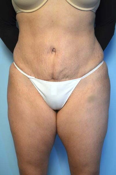 Tummy Tuck Before & After Gallery - Patient 606274 - Image 2