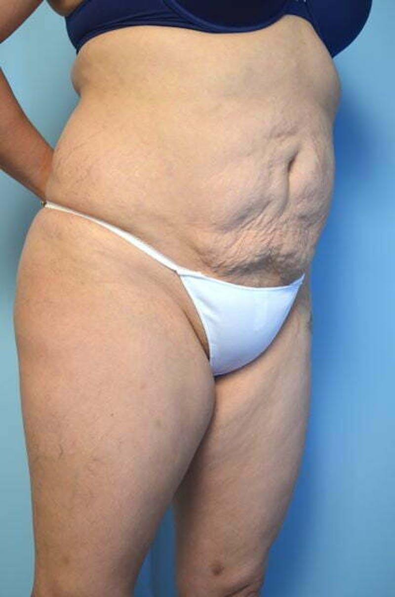 Liposuction Before & After Gallery - Patient 309381 - Image 3