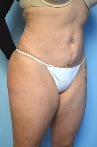 Liposuction Before & After Gallery - Patient 309381 - Image 4