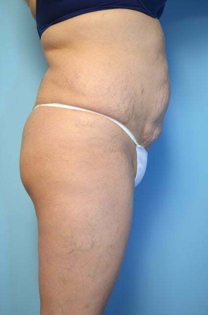 Liposuction Before & After Gallery - Patient 309381 - Image 5