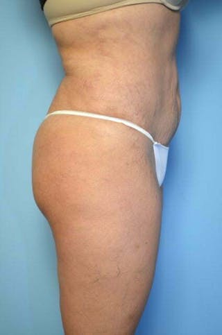 Liposuction Before & After Gallery - Patient 309381 - Image 6