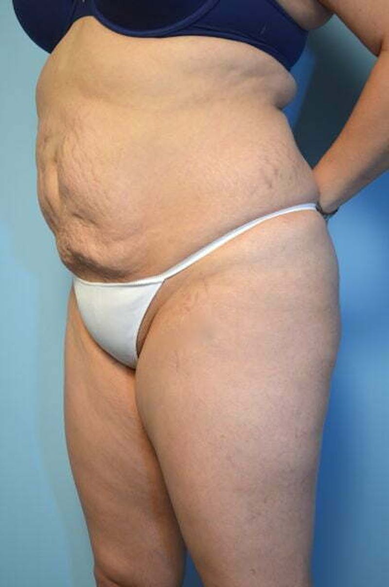 Liposuction Before & After Gallery - Patient 309381 - Image 7