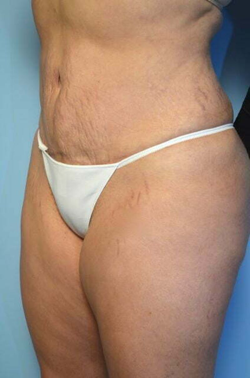 Liposuction Before & After Gallery - Patient 309381 - Image 8