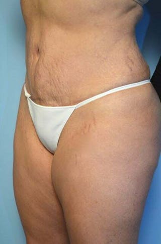 Liposuction Before & After Gallery - Patient 309381 - Image 8