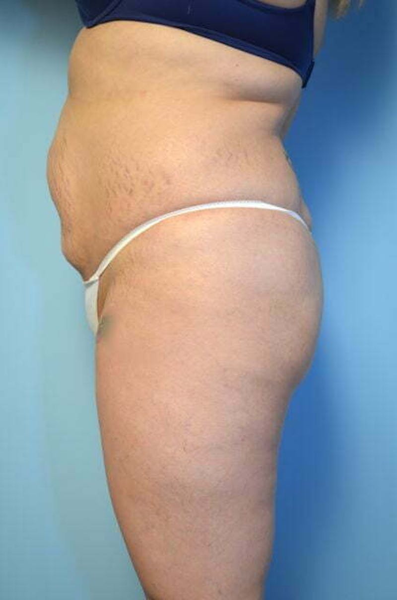 Liposuction Before & After Gallery - Patient 309381 - Image 9