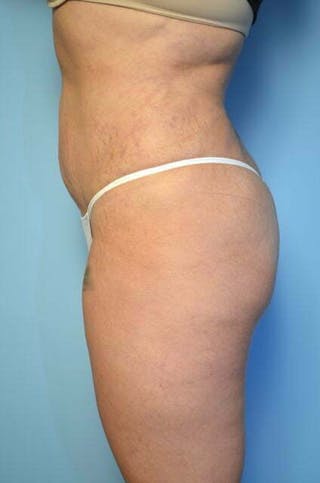 Liposuction Before & After Gallery - Patient 309381 - Image 10
