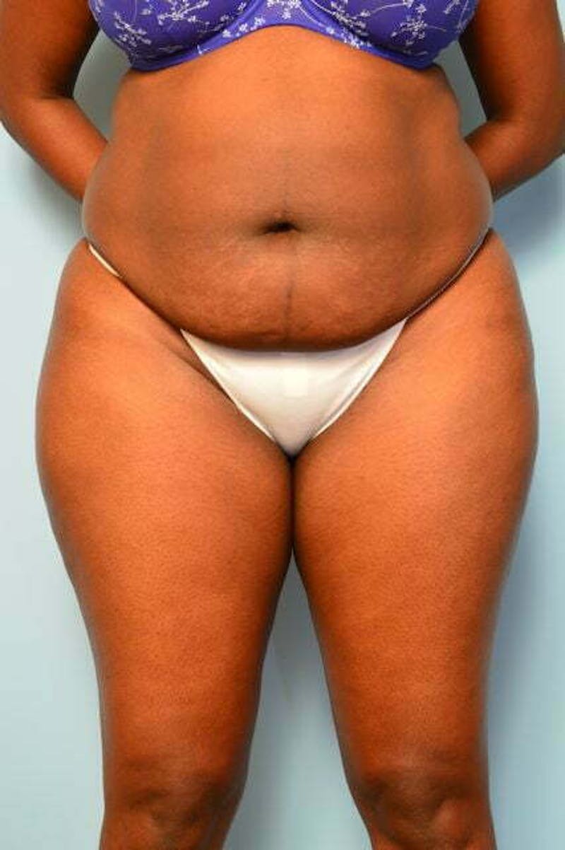 Liposuction Before & After Gallery - Patient 284770 - Image 1