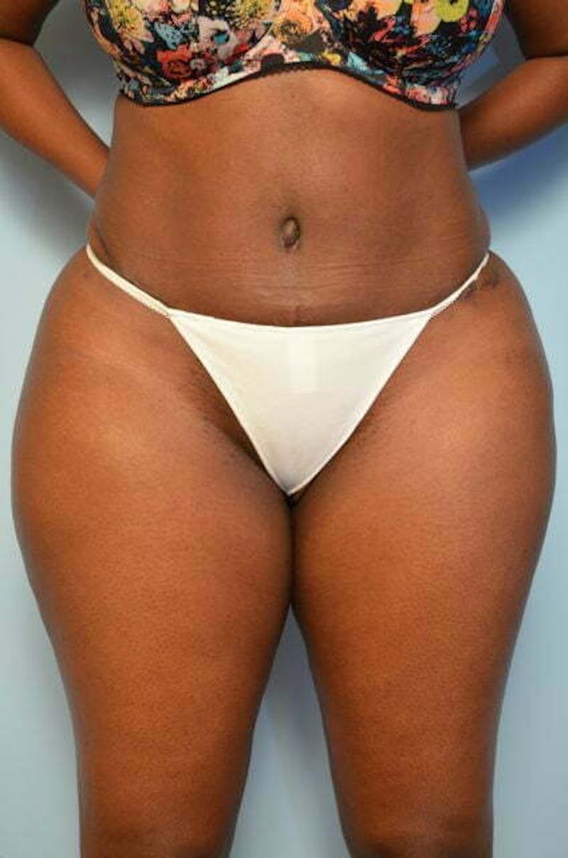 Liposuction Before & After Gallery - Patient 284770 - Image 2