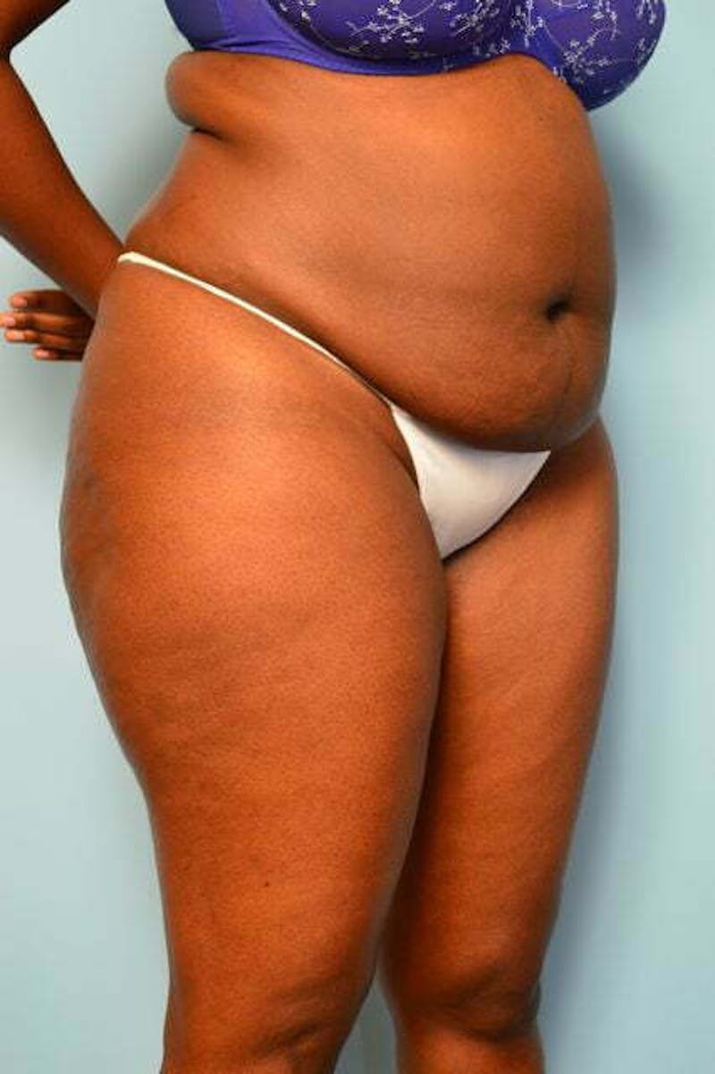 Liposuction Before & After Gallery - Patient 284770 - Image 3