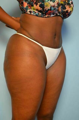 Liposuction Before & After Gallery - Patient 284770 - Image 4