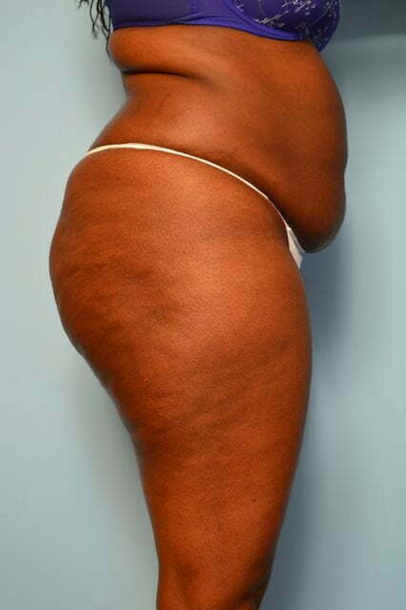 Liposuction Before & After Gallery - Patient 284770 - Image 5