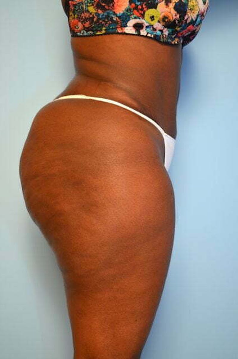 Liposuction Before & After Gallery - Patient 284770 - Image 6
