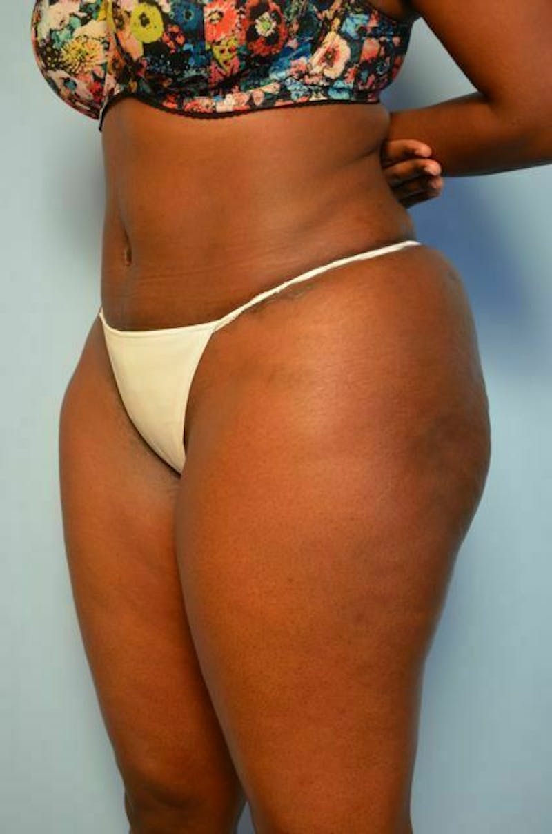 Liposuction Before & After Gallery - Patient 284770 - Image 8