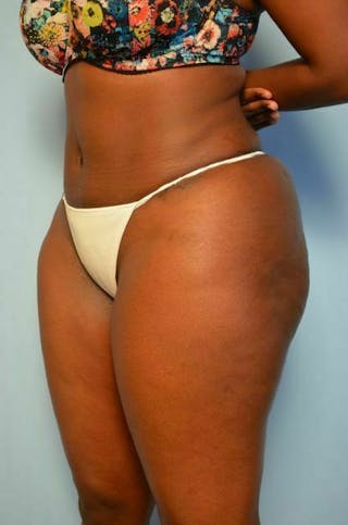 Liposuction Before & After Gallery - Patient 284770 - Image 8